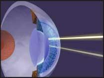 Unlike in conventional excimer laser surgery for vision correction, ultrafast laser pulses ablate material within the cornea without the need to cut an external flap.