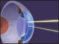 Unlike in conventional excimer laser surgery for vision correction, ultrafast laser pulses ablate material within the cornea without the need to cut an external flap. Unlike in conventional excimer laser surgery for vision correction, ultrafast laser pulses ablate material within the cornea without the need to cut an external flap.