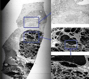 A large-image-area laser-confocal microscope can capture many types of images. Monochrome transmitted-light (top) and autofluorescence (bottom) images were obtained of an unstained ovarian tumor section, both at an optical resolution of 2 &micro;m. The 10 &times; 30-mm specimen was scanned with 532-nm laser light. The transmitted-light image was enhanced with equalization contrast, while the fluorescent image was enhanced with logarithmic contrast and a false-color palette. The specimen was provided by David Hedley of the Princess Margaret Hospital (Toronto, Ont., Canada). The microscope can also produce full-color images.