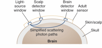FIGURE 1. CAS Medical&rsquo;s FORE-SIGHT system projects NIR light into the brain to quantify specific elements found in blood and brain tissue and produce an absolute measurement indicating cerebral-tissue oxygen saturation.