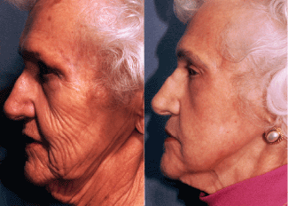 FIGURE 1. Before and after pictures of carbon dioxide laser skin resurfacing show the results that can be achieved with this procedure. Typical healing time is three to four weeks, though redness can remain for up to four months.