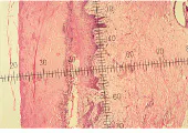 Histologic slide at top reveals tissue effects of a chemical peel one week post operatively. The micron scale through the center of the slide shows how deep a chemical burn can go. In comparison, immediately after three passes with an UltraPulse CO2 laser (250 mJ/pulse), the residual thermal damage is 70 µm deep (middle slide). One week after the laser treatment, the area has already healed considerably (bottom slide). Histologic slide at top reveals tissue effects of a chemical peel one week post operatively. The micron scale through the center of the slide shows how deep a chemical burn can go. In comparison, immediately after three passes with an UltraPulse CO2 laser (250 mJ/pulse), the residual thermal damage is 70 µm deep (middle slide). One week after the laser treatment, the area has already healed considerably (bottom slide).