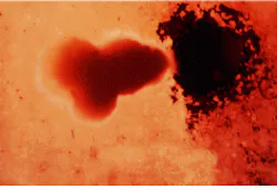 FIGURE 3. Ablation with an Er:YAG laser (left, with water; right, without water) creates holes in dental composite restorative material. Note the char created when water is not used for cooling. FIGURE 3. Ablation with an Er:YAG laser (left, with water; right, without water) creates holes in dental composite restorative material. Note the char created when water is not used for cooling.