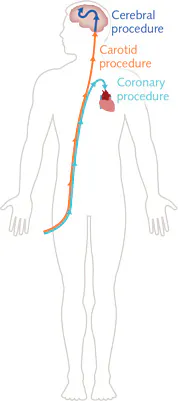 FIGURE 2. A schematic shows the route taken through the human body by a catheter used for coronary, carotid, and cerebral procedures. FIGURE 2. A schematic shows the route taken through the human body by a catheter used for coronary, carotid, and cerebral procedures.