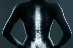 Content Dam Bow Online Articles 2016 08 Mit Epidural Placement Web Content Dam Bow Online Articles 2016 08 Mit Epidural Placement Web