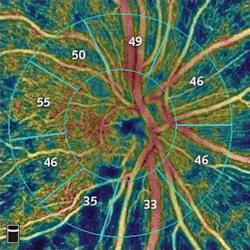 Technology newly approved by the FDA provides quantitative measurement of blood-vessel density in the optic disc; this image, taken from a patient with glaucoma, shows loss of retinal nerve fiber. Technology newly approved by the FDA provides quantitative measurement of blood-vessel density in the optic disc; this image, taken from a patient with glaucoma, shows loss of retinal nerve fiber.