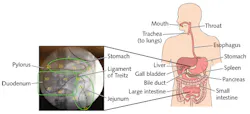 FIGURE 5. FBG-based medical quasi-distributed pressure sensors provide in vivo data of the human digestive system. FIGURE 5. FBG-based medical quasi-distributed pressure sensors provide in vivo data of the human digestive system.