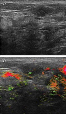 Masses initially categorized as BI-RADS 4a and suspicious on ultrasound because of irregular shape and microlobulation (a) were ultimately downgraded as nonsuspicious (BI-RADS 3) with OA/US technology (b) because of benign-appearing internal and capsular vessels.