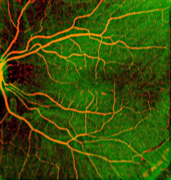FIGURE 1. Angiographic OCT fundus image of human retina obtained by swept-source optical coherence tomography (SS-OCT) using a 1050 nm MEMS-VCSEL. Retinal vasculature (red) is superimposed on rich choroidal vessels (green background). Total image size is 12 &times; 12 mm, and no dye was injected to obtain the image.