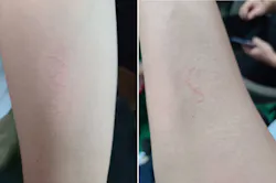 FIGURE 5. Less erythema can be seen after the treatment by the Focuslight demo system under 10 ms, at 10 mJ/spot. FIGURE 5. Less erythema can be seen after the treatment by the Focuslight demo system under 10 ms, at 10 mJ/spot.