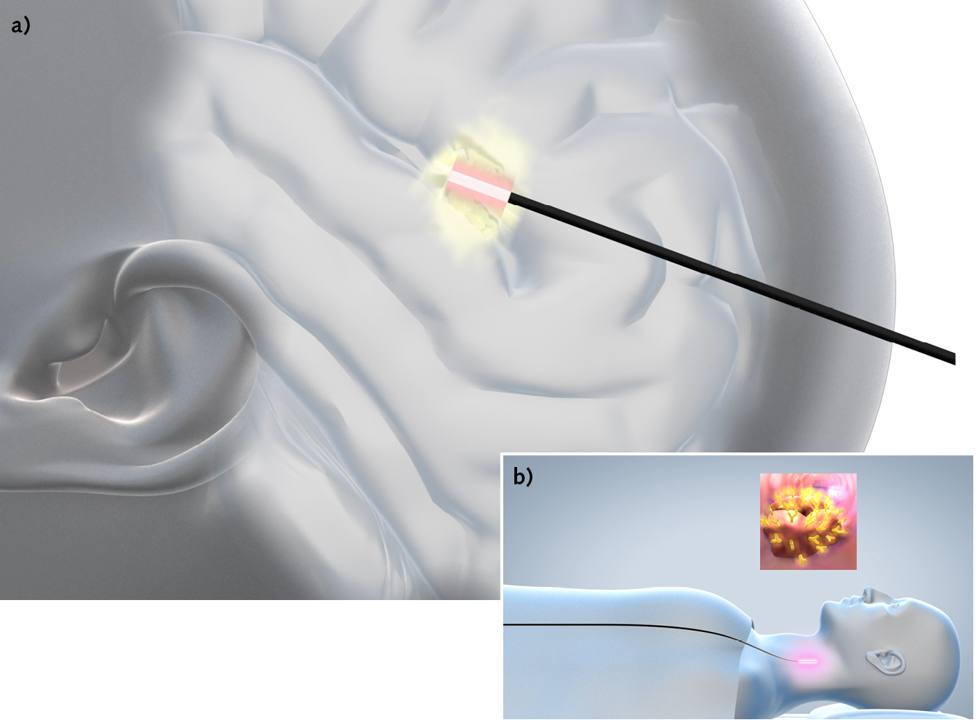 FIGURE 1. Laser-induced thermal therapy (LITT; a) and photodynamic therapy/ photoimmunotherapy (PDT/PIT; b) are used to treat cancer and other severe pathologies.