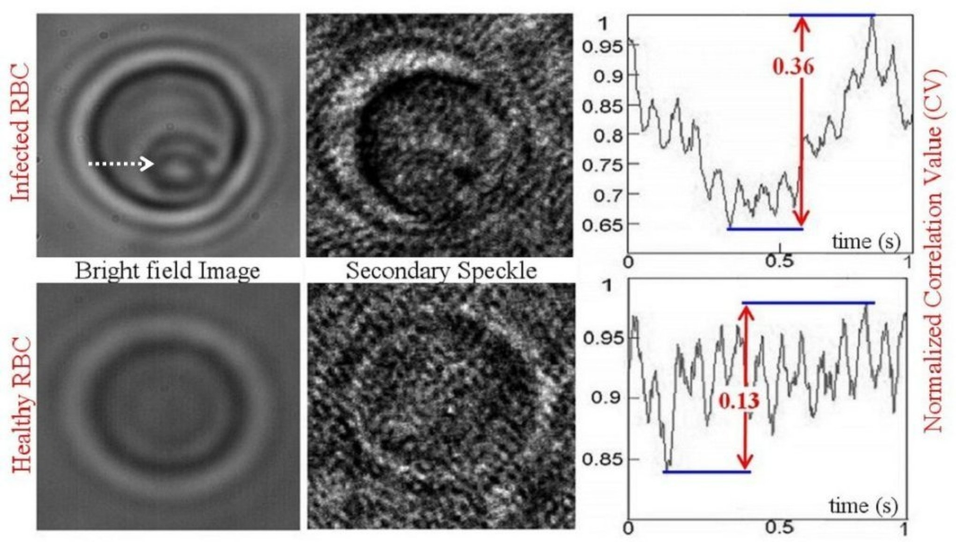 The difference between an infected red blood cell (top) and a healthy cell (bottom) is revealed by secondary speckle sensing microscopy (S3M), in part, by considering the dynamics of the correlation value (CV). CV indicates the similarity between two patterns. One-thousand CVs are calculated from pairs of consecutive speckles acquired in 1 s. As shown in the chart at right, the CV oscillation range for the infected cell (top, 0.36) is almost three times larger than that of the healthy red blood cell (bottom, 0.13). In the top left image of the infected cell, a parasitic life-cycle stage of malaria, called 'trophozoite,' can be seen (arrow).