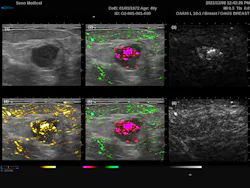 FIGURE 2. Six-panel display of the dual-mode PAI-ultrasound scan of a breast cancer tumor. Image (1) displays the grayscale ultrasound, (2) the grayscale ultrasound with the combined 757 nm (red) and 1064 nm (green) photoacoustic (PA) signals, (3) grayscale 757 nm PA signal, (4) grayscale ultrasound with the combined PA signal, (5) grayscale ultrasound with the combines 757 nm (red) and 1064 nm (green) PA signals filtered to reduce aliasing, and (6) grayscale 1064 nm PA signal. FIGURE 2. Six-panel display of the dual-mode PAI-ultrasound scan of a breast cancer tumor. Image (1) displays the grayscale ultrasound, (2) the grayscale ultrasound with the combined 757 nm (red) and 1064 nm (green) photoacoustic (PA) signals, (3) grayscale 757 nm PA signal, (4) grayscale ultrasound with the combined PA signal, (5) grayscale ultrasound with the combines 757 nm (red) and 1064 nm (green) PA signals filtered to reduce aliasing, and (6) grayscale 1064 nm PA signal.