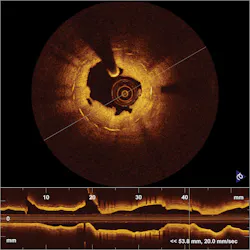 FIGURE 3. OCT highlights in-stent restenosis in a patient who has just undergone balloon dilatation. FIGURE 3. OCT highlights in-stent restenosis in a patient who has just undergone balloon dilatation.
