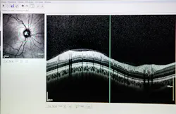 FIGURE 4. OCT image of the optic nerve. FIGURE 4. OCT image of the optic nerve.
