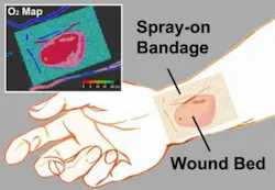 A transparent liquid bandage displays a quantitative, oxygenation-sensitive color map that can be easily acquired using a simple camera or smartphone. A transparent liquid bandage displays a quantitative, oxygenation-sensitive color map that can be easily acquired using a simple camera or smartphone.