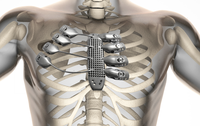 3d Printed Sternum Retrofits To Patient S Anatomy Machine Design