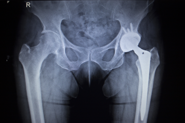 Additive Orthopedics Market Drives 500 M In Revenue Opportunities Machine Design