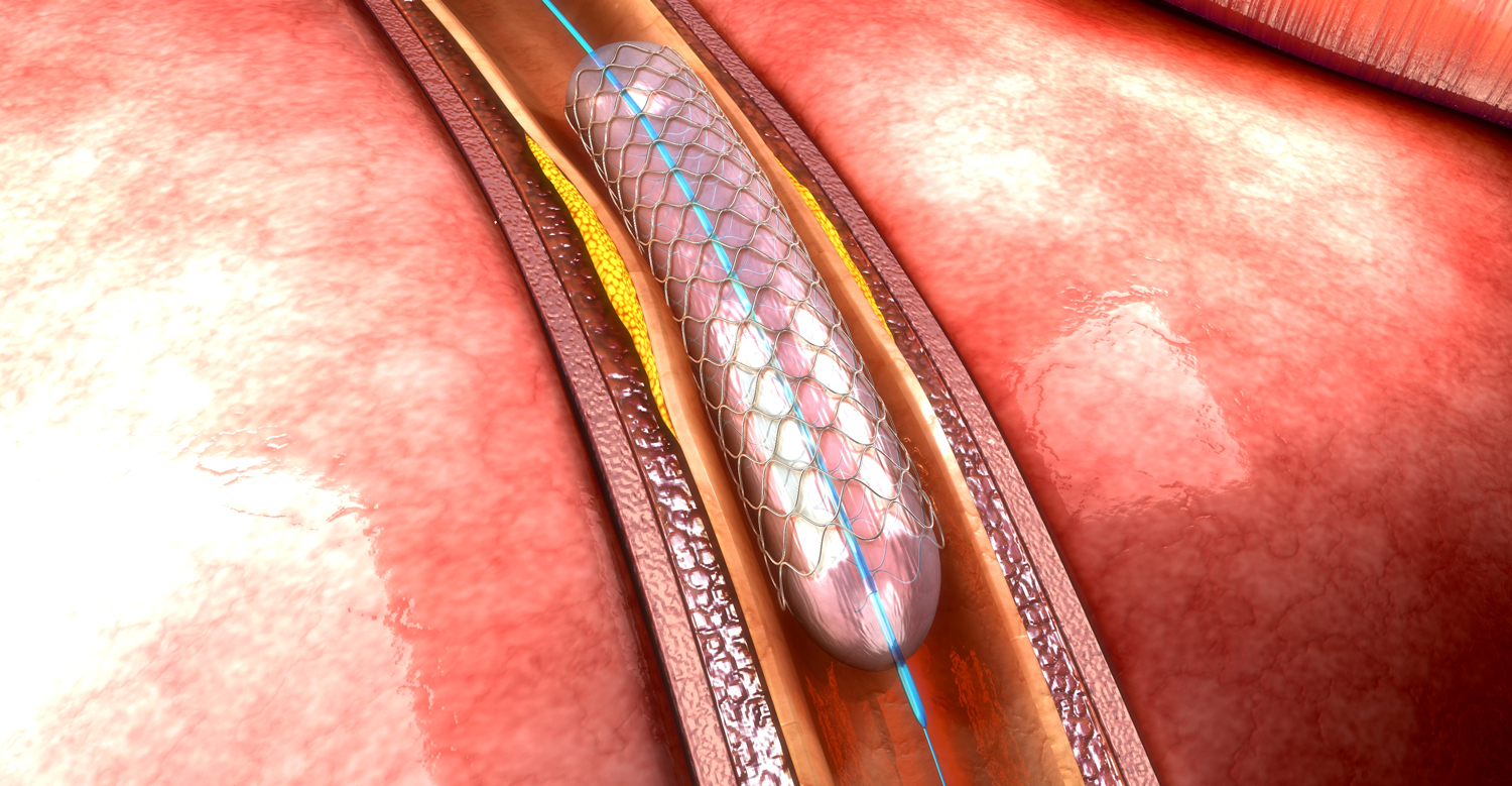 Stent