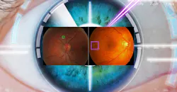 Eye surgery Eye surgery