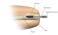 After the first surgical operation, the connector—a titanium implant—is inserted and fixed to the lower end of the femur. After the first surgical operation, the connector—a titanium implant—is inserted and fixed to the lower end of the femur.