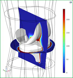 This image quantifies the tissue damage during treatment using the standard thermal dose metric CEM43 methodology. This image quantifies the tissue damage during treatment using the standard thermal dose metric CEM43 methodology.
