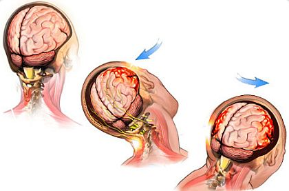 DARPA seeks to develop implantable device to help brain-injured people regain their memories