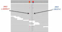 Figure 2. Targeted sequencing of an MPN sample clearly reveals the two JAK2 mutations that were missed by ddPCR. Figure 2. Targeted sequencing of an MPN sample clearly reveals the two JAK2 mutations that were missed by ddPCR.