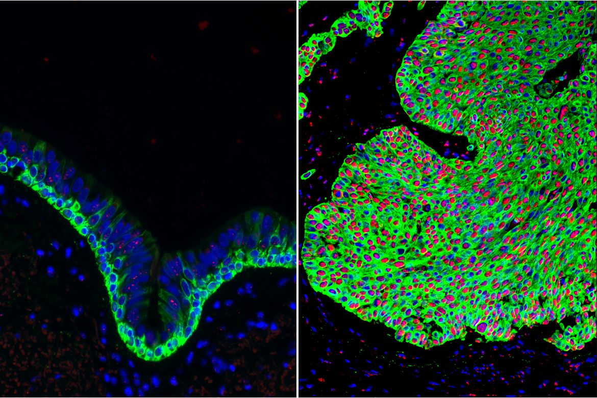 Normal airway tissue, left, and lung cancer tissue, right, with an overabundance of basal stem cells (green). The activated form of beta-catenin (red) in the lung cancer can be targeted by the Wnt Inhibitor Compound 1.