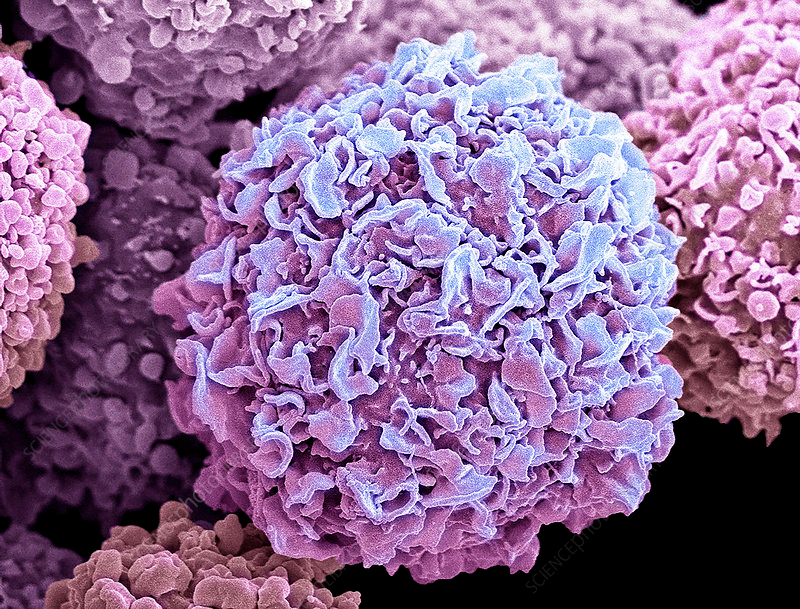 Colored scanning electron micrograph (SEM) of breast cancer cells. Image courtesy of Steve Gschmeissner/SPL