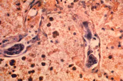 Cdc Cancer Cells 22244 5ef35131ec3b0 Cdc Cancer Cells 22244 5ef35131ec3b0