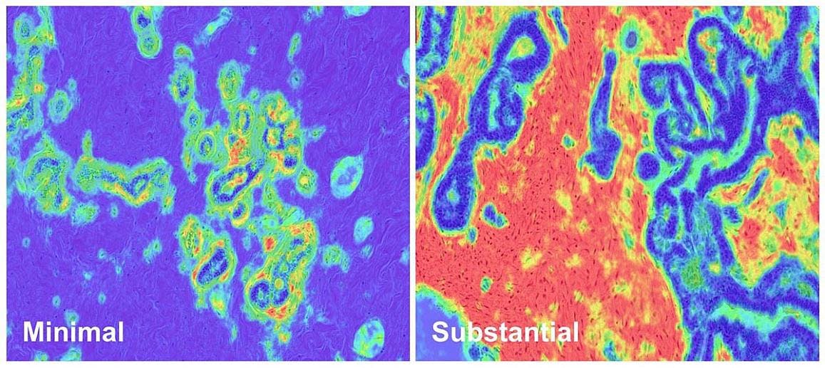 Slides showing minimal disruption (left) and substantial disruption (right) in breast stromal tissue. Courtesy of NIH/NCI.