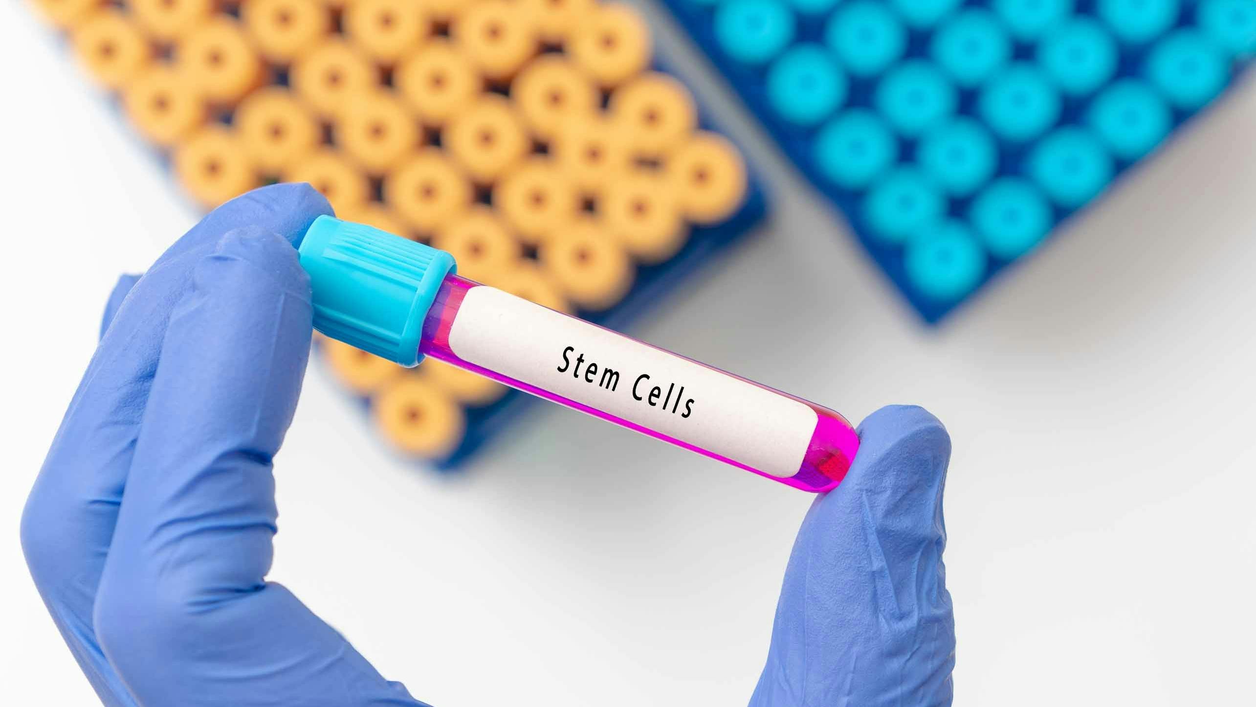 Blood sample tube contain stem cells for cell therapy blood sample in test tube on doctor hand in medical lab