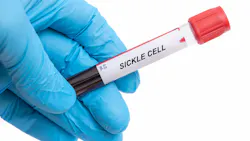 Sickle Cell. Sickle Cell disease blood test in doctor hand Sickle Cell. Sickle Cell disease blood test in doctor hand
