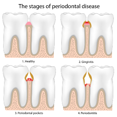 Stages Of Periodontal Disease