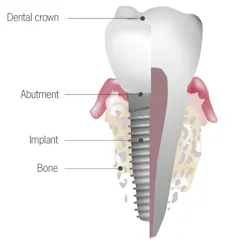 Tooth Dental Implant Illustration Tooth Dental Implant Illustration
