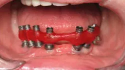 Figure 1: The purpose of an implant verification jig is to mimic the fit of the final frame. A verification jig allows you to verify the accuracy of the model and ensure an accurate final frame every time. Figure 1: The purpose of an implant verification jig is to mimic the fit of the final frame. A verification jig allows you to verify the accuracy of the model and ensure an accurate final frame every time.