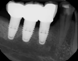 18may10piaclintip01 18may10piaclintip01