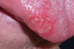 18aug9piaclintip03 18aug9piaclintip03