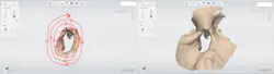 Figure 1: The TRIOS scan of a maxillofacial defect is started on the defect border in an area with great surface detail (as seen at left encircled in red) and built by scanning in the outward circular pattern drawn in red to yield an accurately stitched finalized scan (at right). Figure 1: The TRIOS scan of a maxillofacial defect is started on the defect border in an area with great surface detail (as seen at left encircled in red) and built by scanning in the outward circular pattern drawn in red to yield an accurately stitched finalized scan (at right).