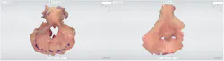 Figure 5: This patient lost his nose to squamous cell carcinoma. To help in the design of the nasal prosthetic, a “donor” TRIOS scan was completed of the patient’s daughter’s nose. Figure 5: This patient lost his nose to squamous cell carcinoma. To help in the design of the nasal prosthetic, a “donor” TRIOS scan was completed of the patient’s daughter’s nose.