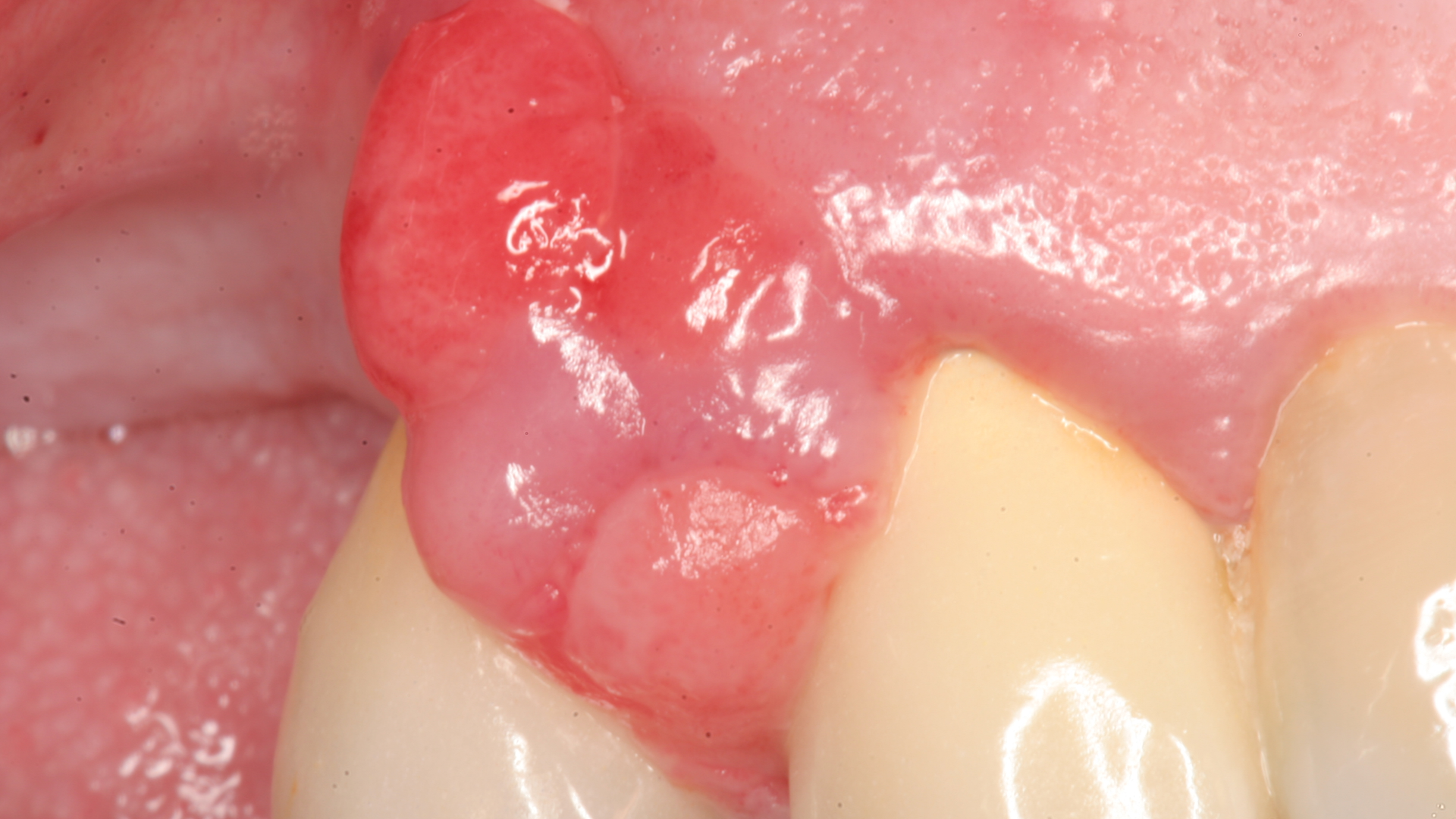 20 Jun11 Pi Aperiotherapy01