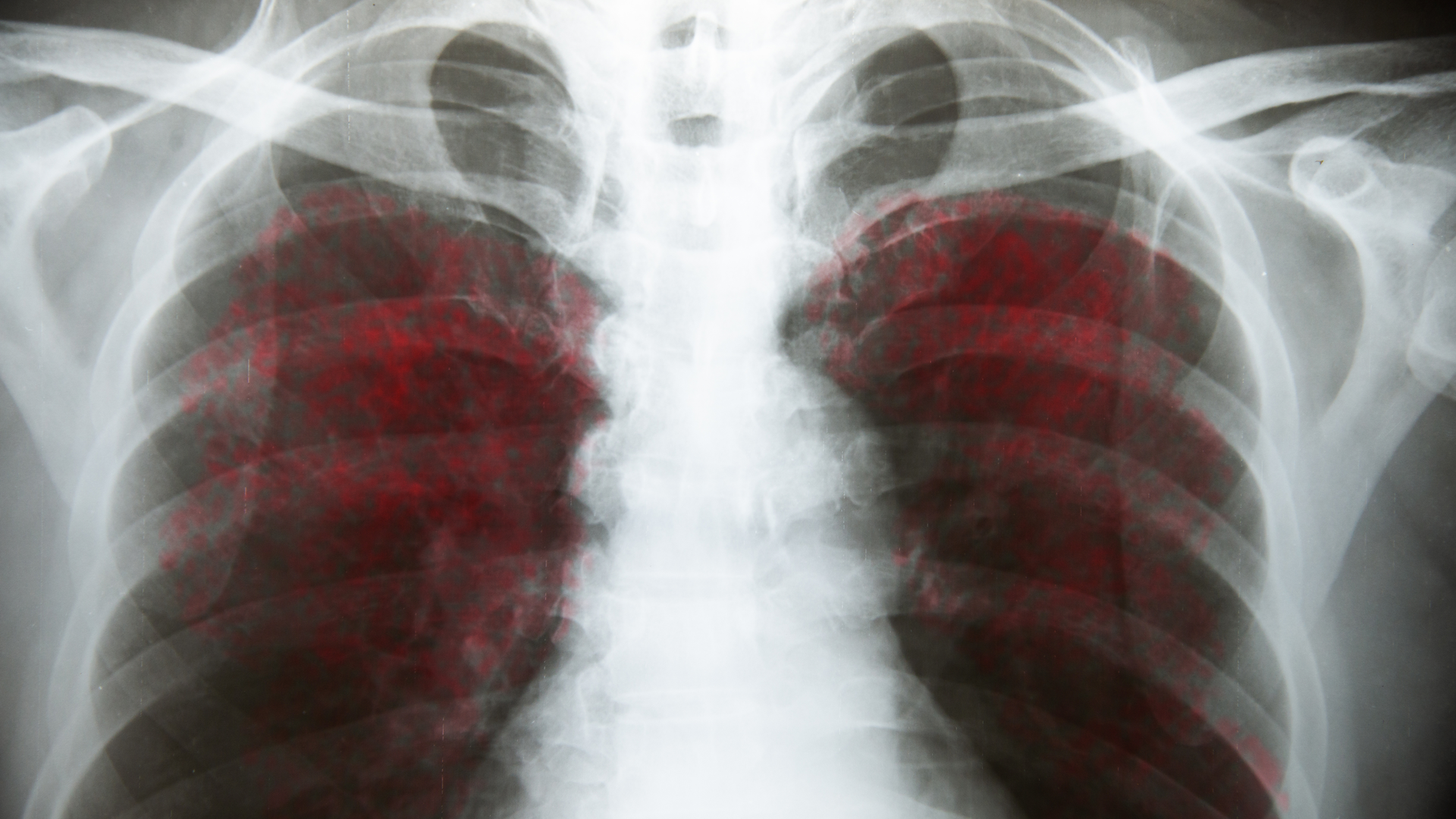 Chirawan Somsanuk Dreamstime Covid 19 Lungs 5f32feca3f820