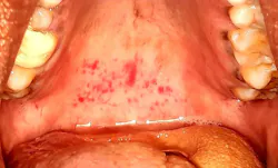 Figure 3: Petechial spots on the hard palate of a COVID-19–positive patient Figure 3: Petechial spots on the hard palate of a COVID-19–positive patient