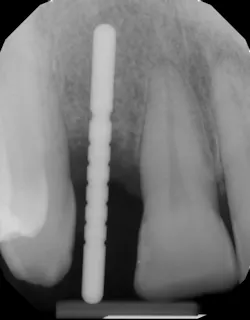 Figure 2: Radiograph of angulation correction with twist drill, showing incomplete bodily correction of osteotomy Figure 2: Radiograph of angulation correction with twist drill, showing incomplete bodily correction of osteotomy