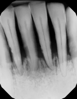 Figure 2: Calculus present after scaling and root planing because of pockets greater than 7 mm and significant bone loss Figure 2: Calculus present after scaling and root planing because of pockets greater than 7 mm and significant bone loss