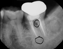 Figure 2: A tooth with both a periodontal and endodontic lesion Figure 2: A tooth with both a periodontal and endodontic lesion