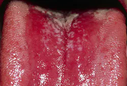 Figure 3: Thrush fungal infection in an immunodeficient patient Figure 3: Thrush fungal infection in an immunodeficient patient