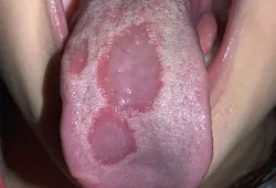 Figure 5: Geographic tongue in a patient with leaky gut and chronic inflammation Figure 5: Geographic tongue in a patient with leaky gut and chronic inflammation