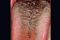 Figure 6: Black, hairy tongue from poor oral hygiene and smoking Figure 6: Black, hairy tongue from poor oral hygiene and smoking